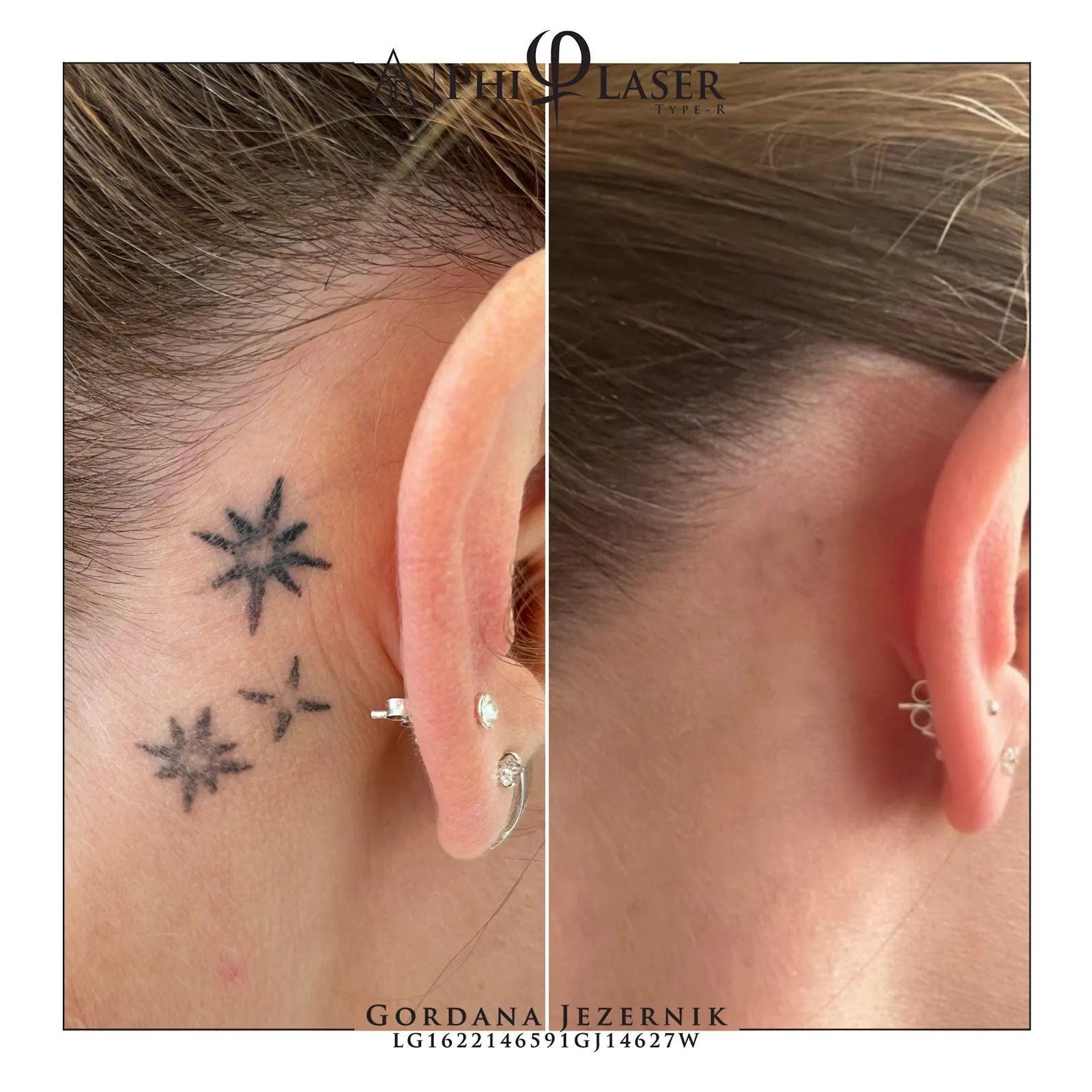 Phi Laser - odstranjevanje tetovaž in permanentnega make upa